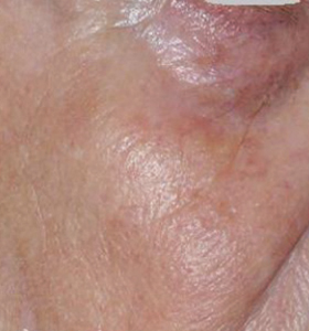 Vascular Lesions Female Face After 2 Treatment . Sharplight