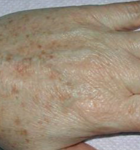 Pigmented Lesions Treatment- Hands Before Treatment . Sharplight