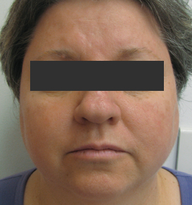 Vascular Lesions Treatment For Middle Aged Woman. After 4 Treatments . Sharplight
