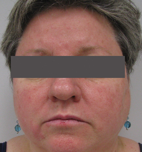 Vascular Lesions Treatment For Middle Aged Woman- Before . Sharplight