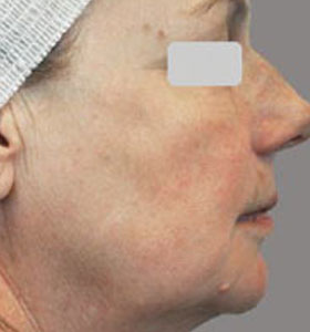 Skin Rejuvenation Treatment For Older Women After 4 Treatments. Sharplight