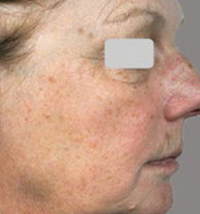 Skin Rejuvenation Treatment For Older Women Before Treatment . Sharplight