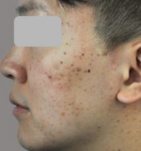 Acne Treatment Type 2 before Treatment . Sharplight