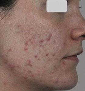 Acne Treatment For Teenage Girl Before Treatment . Sharplight
