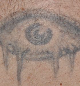 Tattoo Removal Treatment- Eye Before Treatment . Sharplight