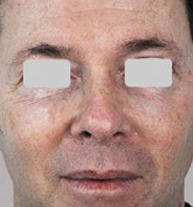 Skin Rejuvenation Treatment For Man Before Treatment . Sharplight