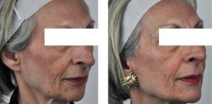 Treatment of aging skin using the SharpLight OmniMax multiple modality  platform - SharplightSharplight