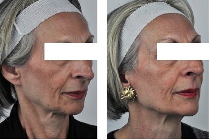 B&A12
