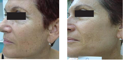 Skin Photo Rejuvenation with the SharpLight DPC Technology