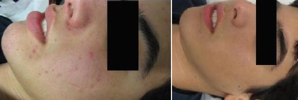 B&A14