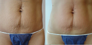 B&A of skin tightening