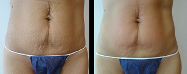 B&A5