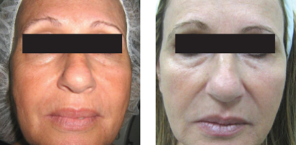 Infrared Technology for Skin Tightening – A Hot Topic Utilizing Deep Dermal Heating