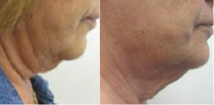 Skin Tightening, Radio Frequency