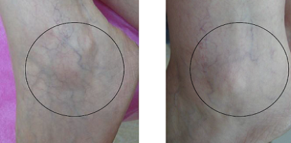 leg veins 2