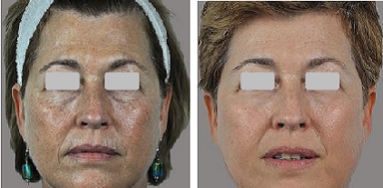 Treatment of aging skin using the SharpLight OmniMax “Stacked” multiple modality platform